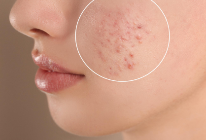 Acne