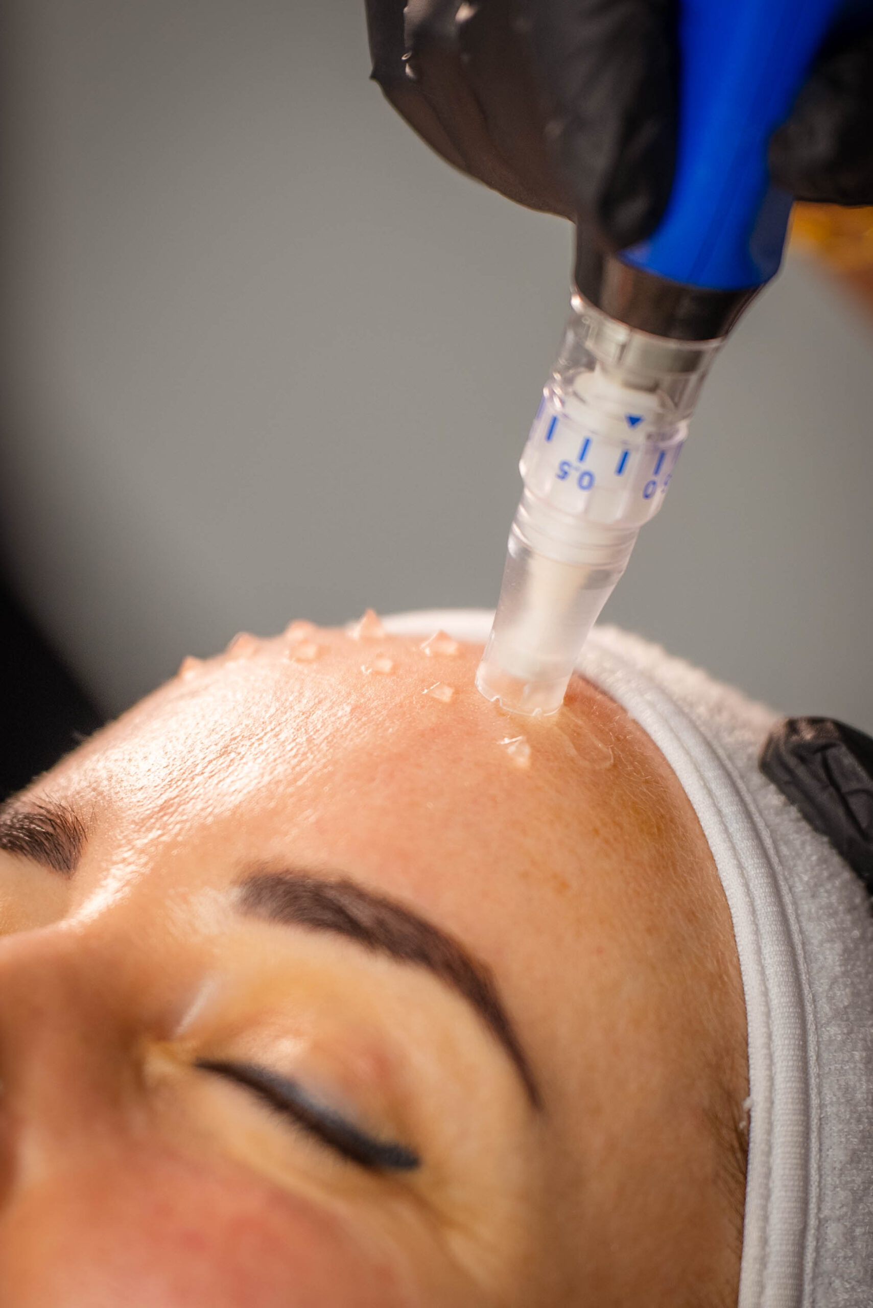 SkinPen microneedling behandeling op het voorhoofd bij Dermacare Den Haag