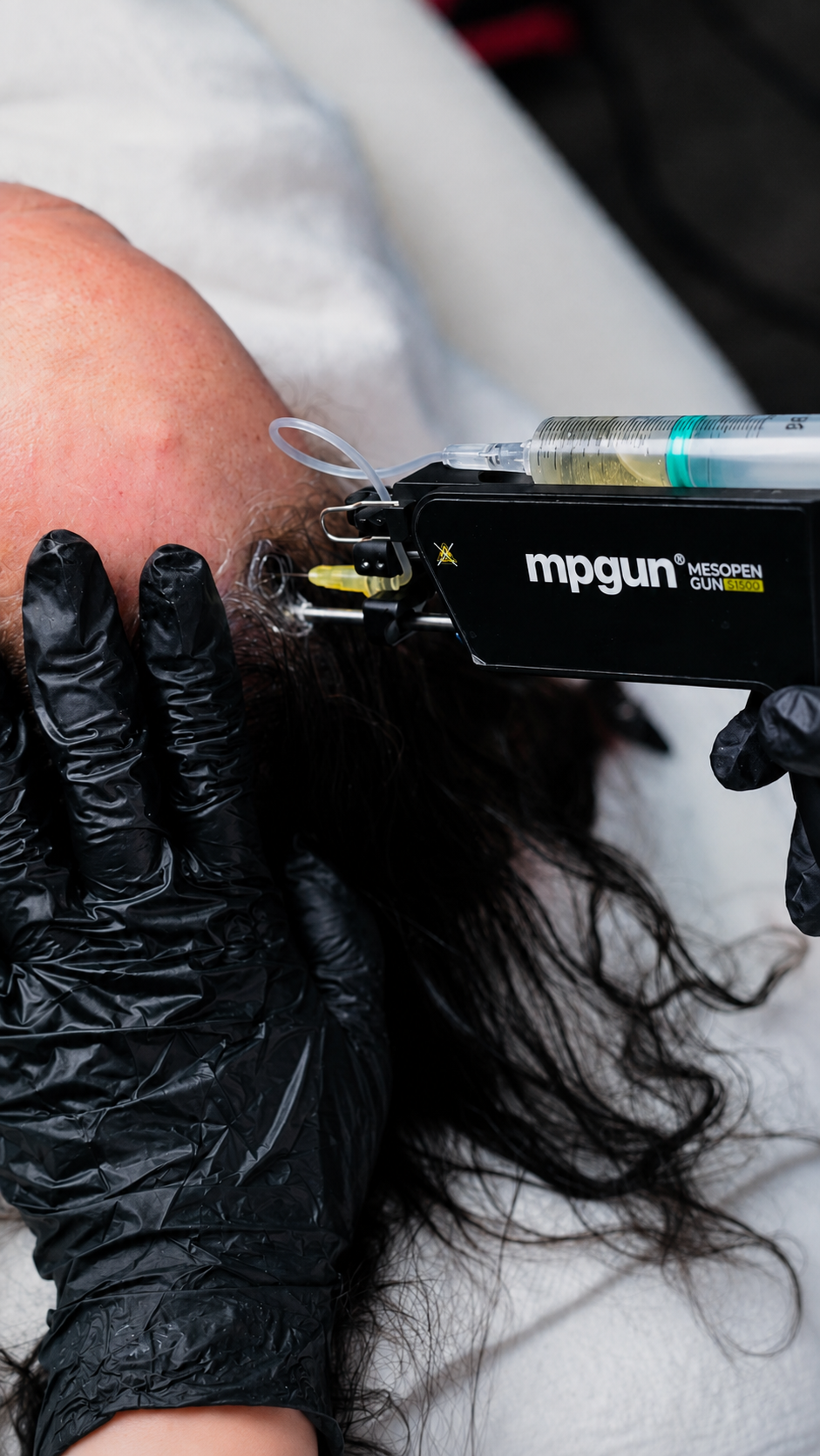 MesoGun hoofdhuid behandeling bij Dermacare